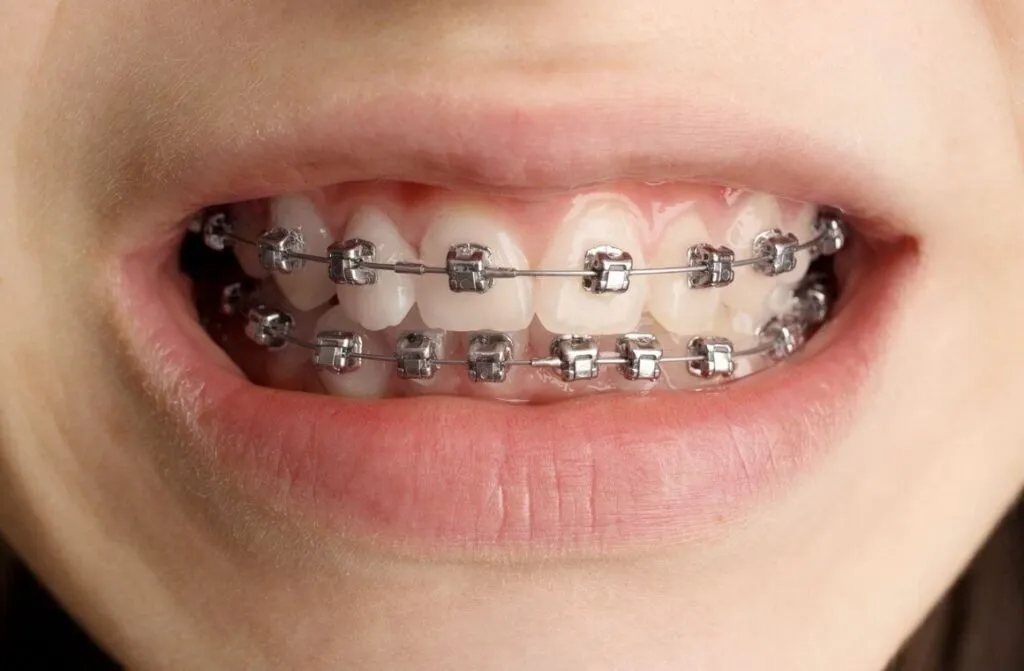 Close-up of a smile with self-ligating braces