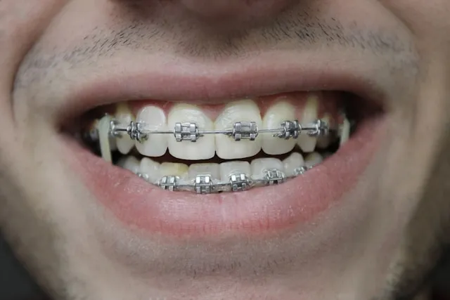 Close-up of a smile with traditional metal braces