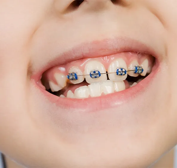 Child's smile with early (Phase 1) braces on the front teeth